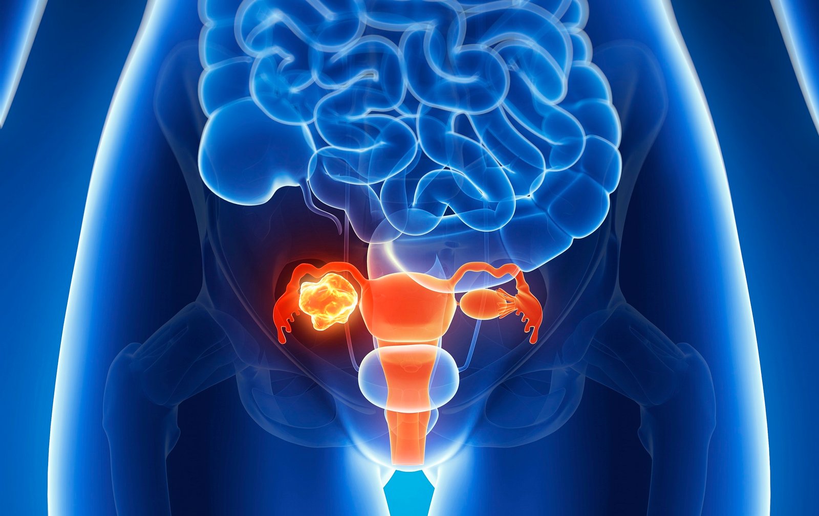 study-finds-origin-of-ovarian-cancer-characterises-genetic-mutation